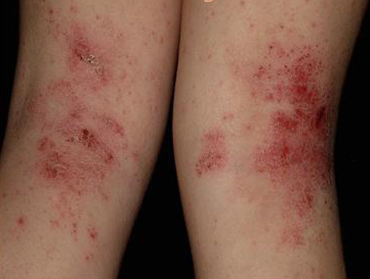 El permanganato de atopicheskogo de la dermatitis